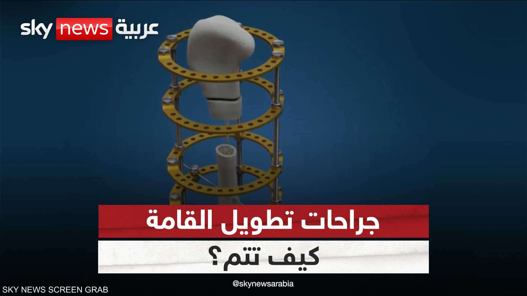 ما الذي يدفع الشخص لإجراء جراحة تطويل القامة؟