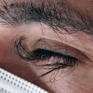 سيبب عقار "بانيتوموماب" مشاكل جلدية لدى 80 بالمئة من المرضى