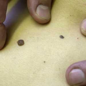 تجربة واعدة لعلاج سرطان لجلد في بريطانيا