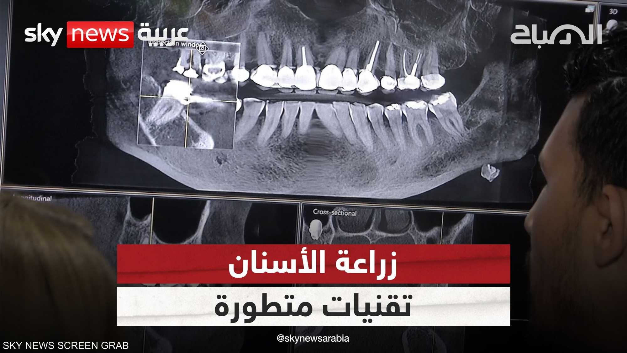 زراعة الأسنان التجميلية.. تقنيات متطورة وحلول سريعة