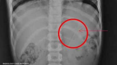 الأشعة تكشف "مفاجأة صادمة" في بطن طفل.. كيف نجا؟