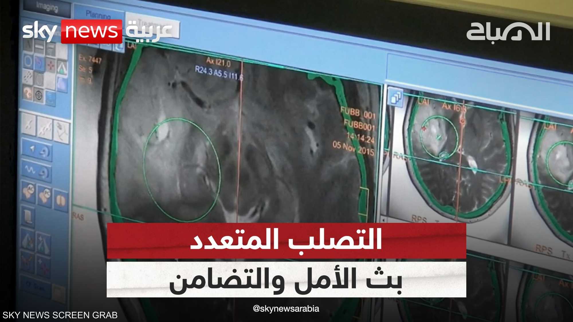 دعوات للتضامن وبث الأمل لمرضى التصلب اللويحي المتعدد