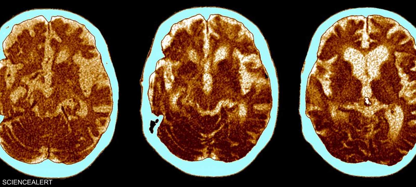 صور أشعة مقطعية لأدمغة مصابة بمرض الزهايمر