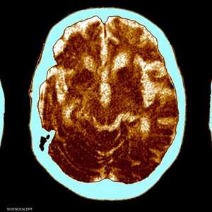 صور أشعة مقطعية لأدمغة مصابة بمرض الزهايمر