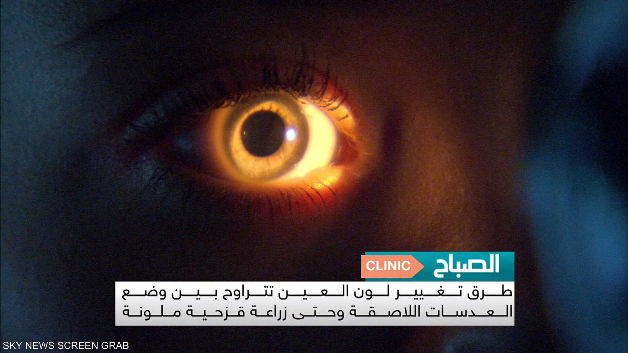 تغيير لون العيون إجراء تجميلي محفوف بالمخاطر