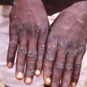 تسجيل حالات إضافية من جدري القردة في أوروبا