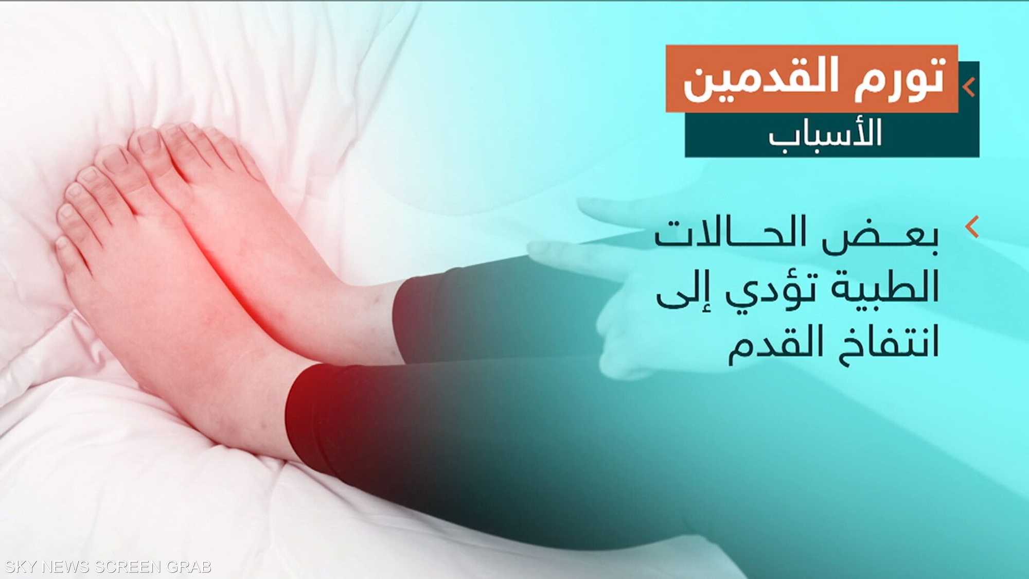 انتفاخ القدمين ينذر بأمراض خطيرة