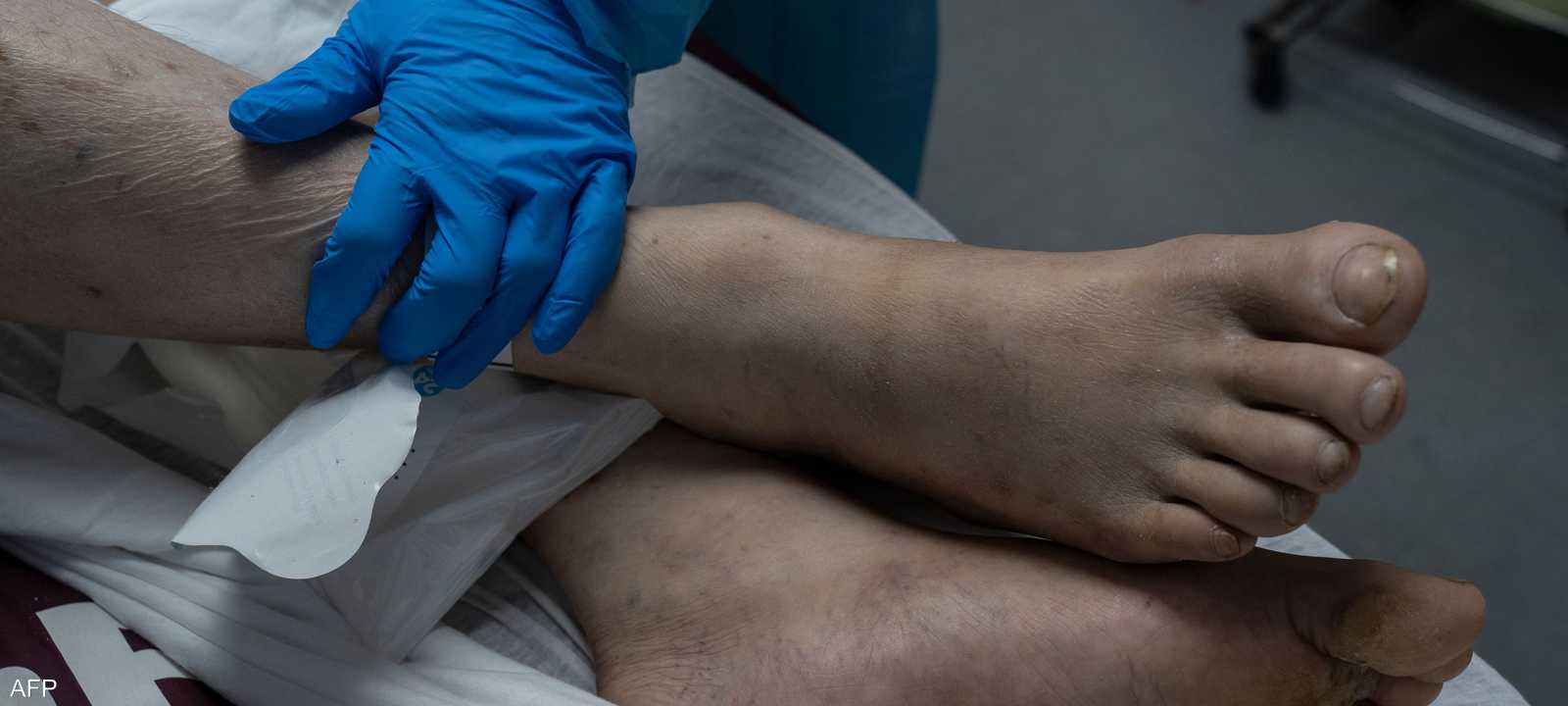 علاقة نعومة الأرجل بالأزمات القلبية