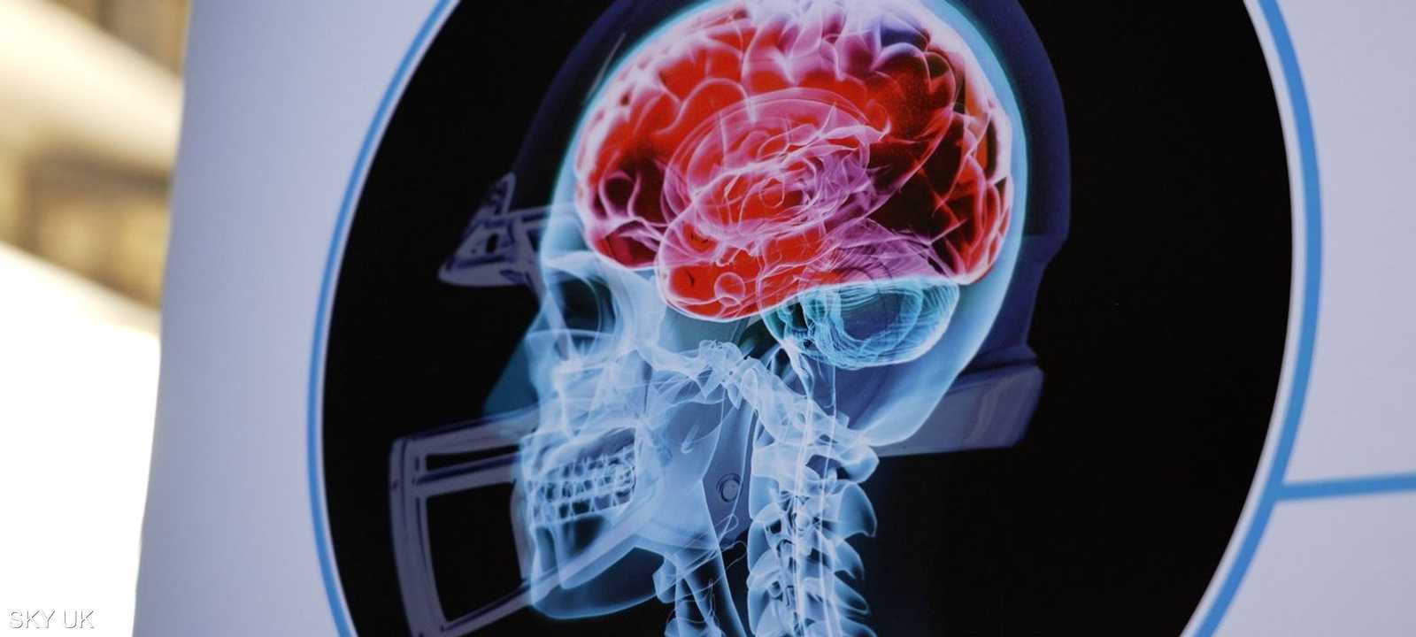 الإصابات المتكررة تنشط فيروس "الهيربس البسيط"