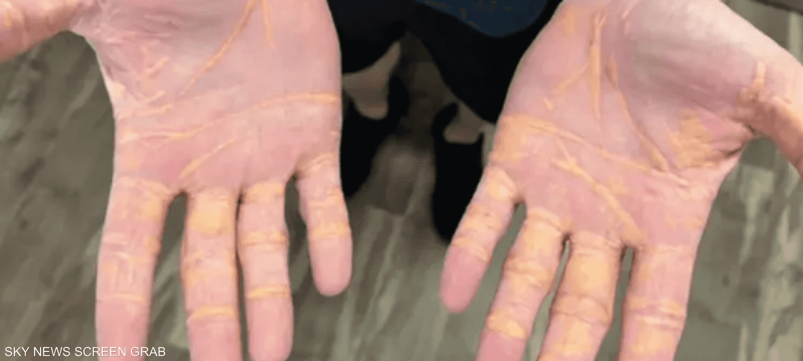 الزانثلازما هي رواسب صفراء من الكوليسترول