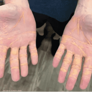 الزانثلازما هي رواسب صفراء من الكوليسترول