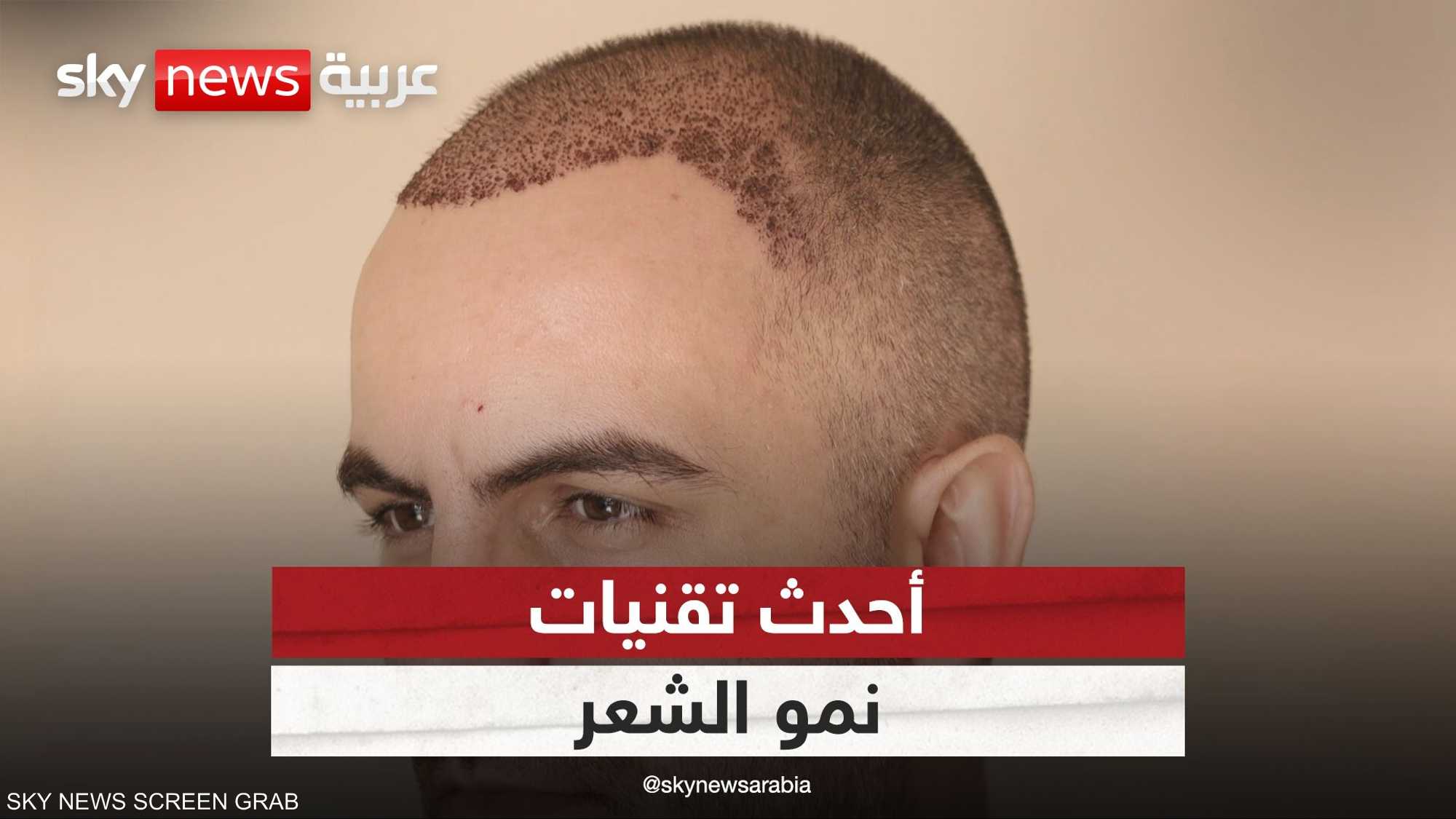 أحدث تقنيات نمو الشعر