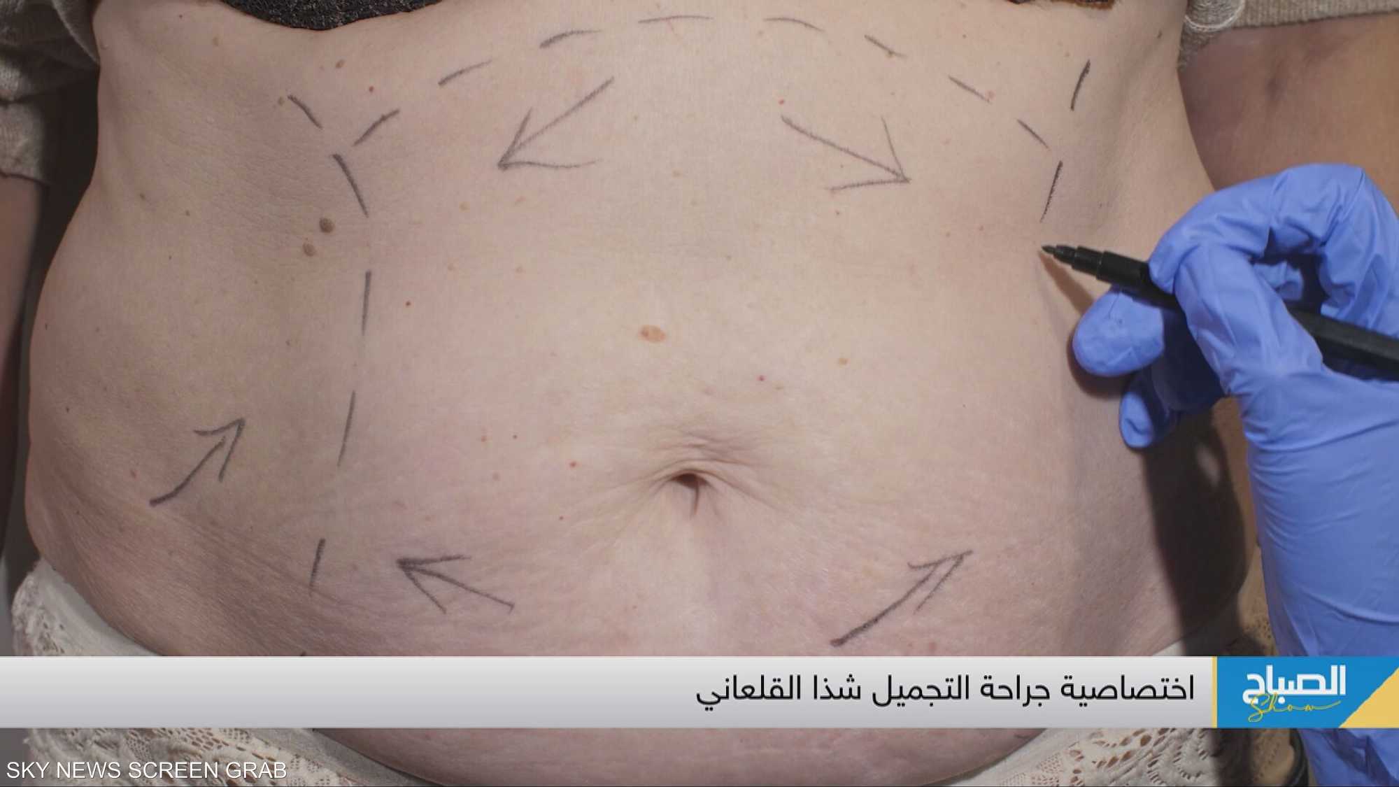 شفط الدهون حل سريع ومثالي لجسم رشيق ومشدود