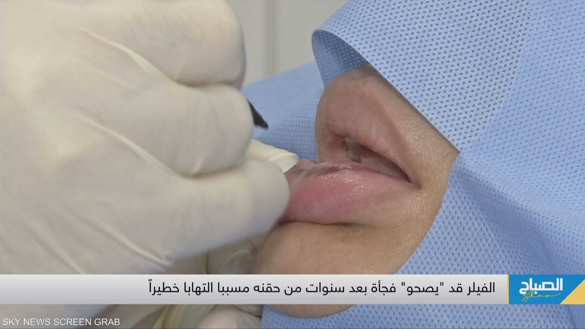 إذابة الفيلر: صيحة جديدة بعالم التجميل هدفها العودة للبساطة