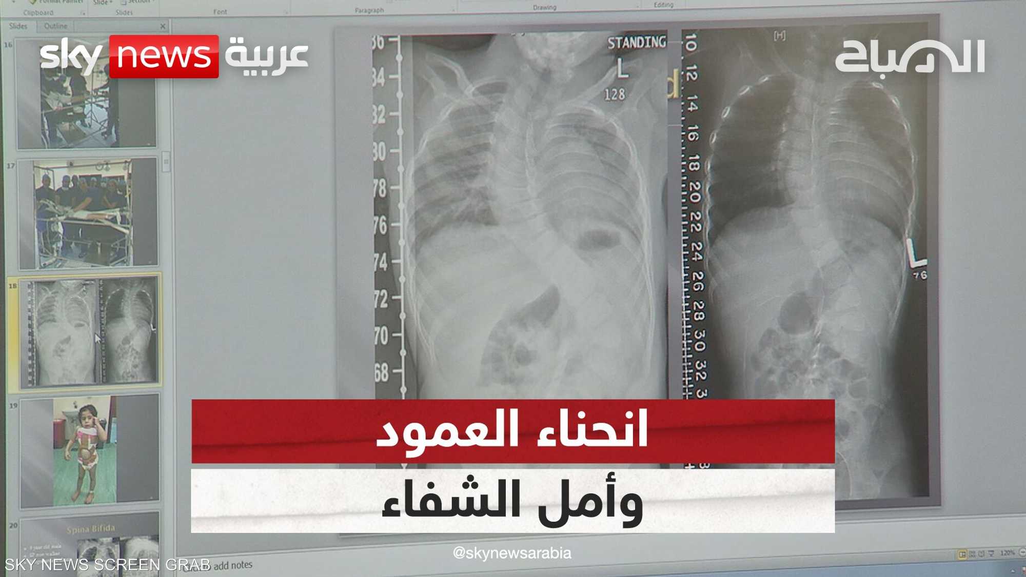 انحناء العمود وأمل الشفاء