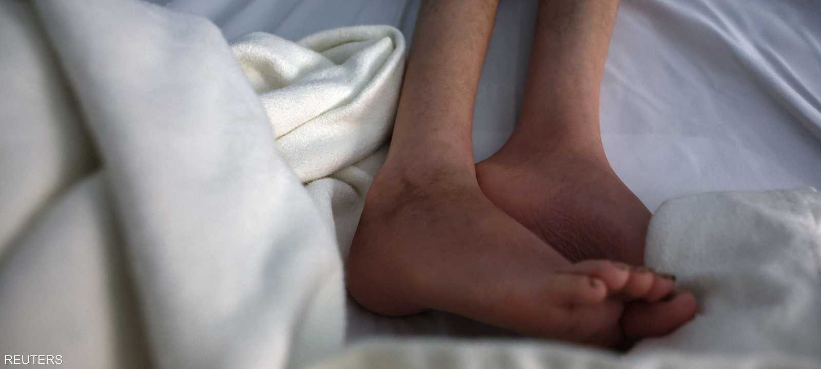 سوء التغذية ينتشر بسرعة في قطاع غزة