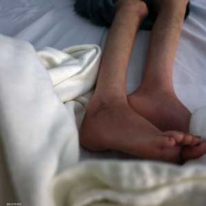 سوء التغذية ينتشر بسرعة في قطاع غزة