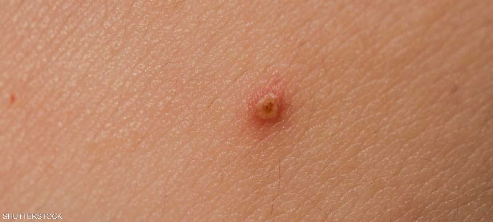 حذر خبير من أن بعض البقع التي تبدو حميدة "قد تكون سرطانية"