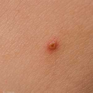 حذر خبير من أن بعض البقع التي تبدو حميدة "قد تكون سرطانية"