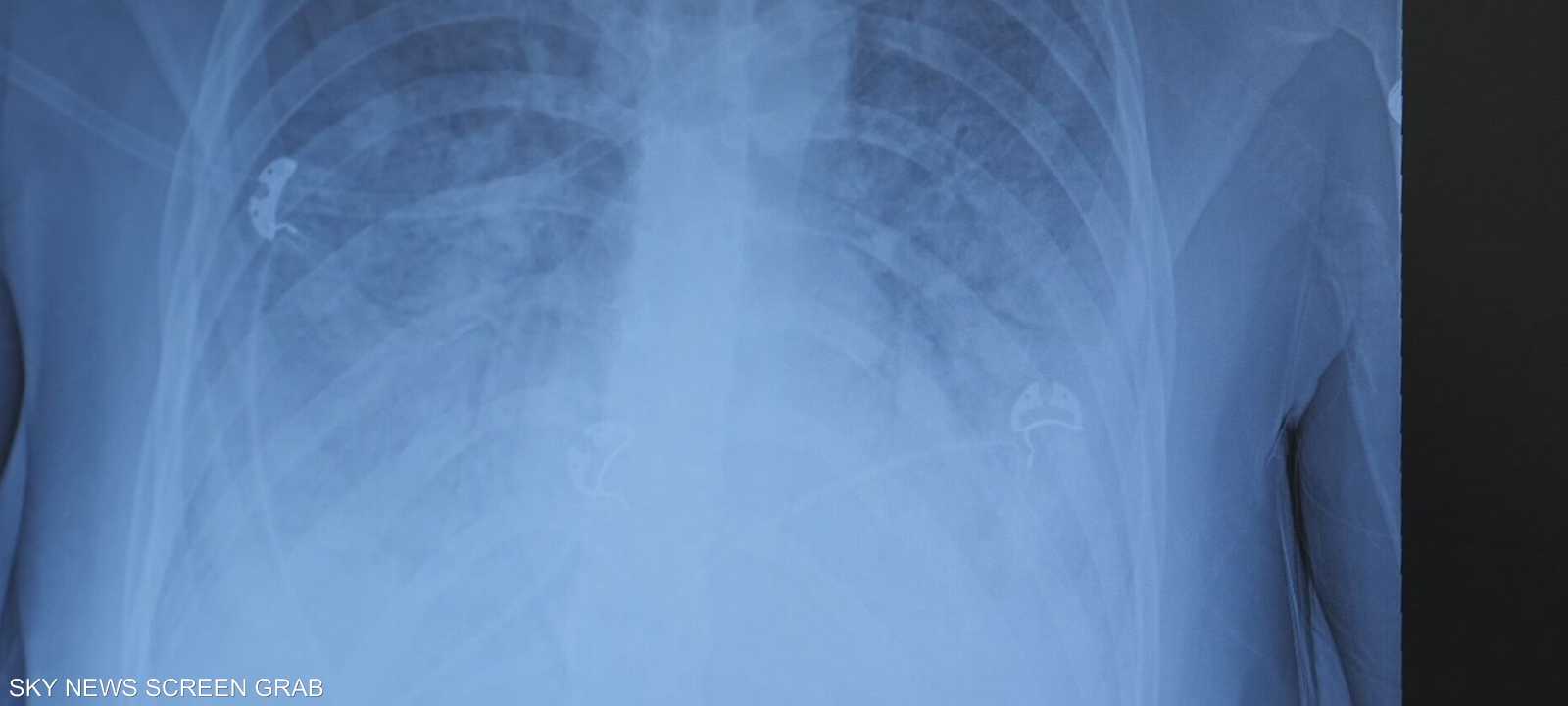 شاب أردني يفقد رئته بسبب الفيب ويدخل رحلة تنفس صناعي