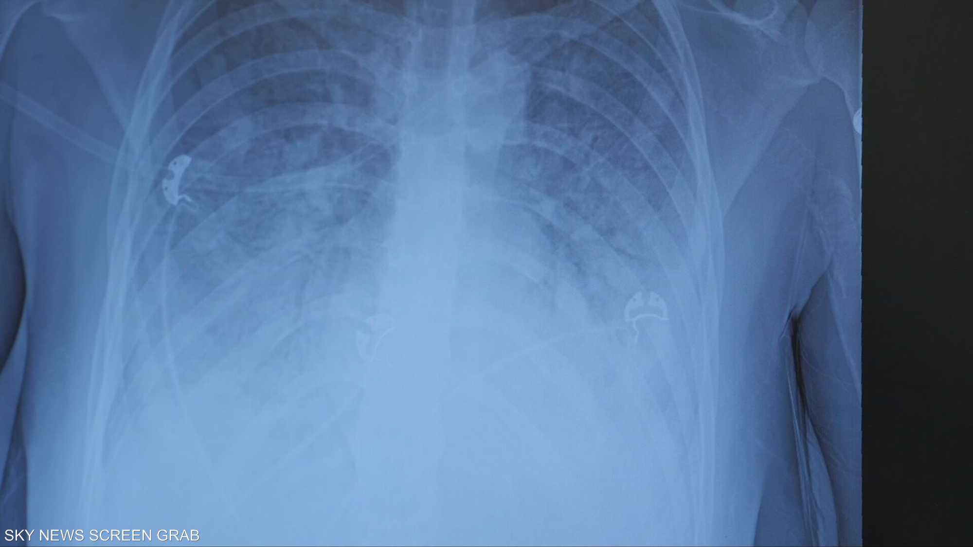 شاب أردني يفقد رئته بسبب الفيب ويدخل رحلة تنفس صناعي