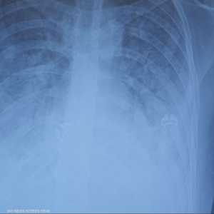 شاب أردني يفقد رئته بسبب الفيب ويدخل رحلة تنفس صناعي