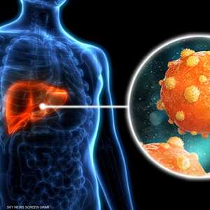 مصر تقترب من القضاء على فيروس "B"