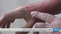 الحقيقة الصادمة عن حروق الشمس.. تلف بالبشرة وشيخوخة