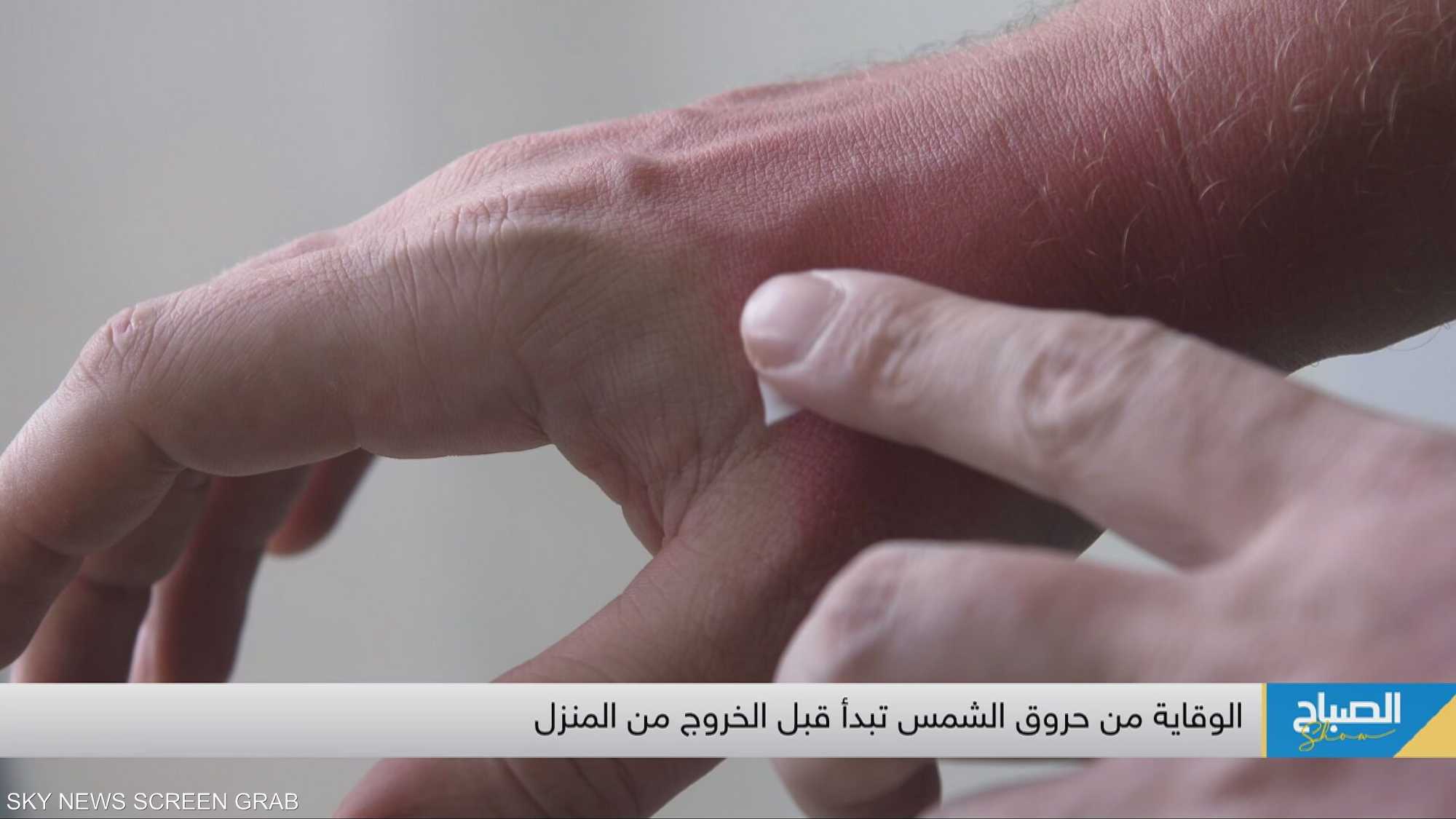 الحقيقة الصادمة عن حروق الشمس.. تلف بالبشرة وشيخوخة