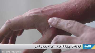 الحقيقة الصادمة عن حروق الشمس.. تلف بالبشرة وشيخوخة