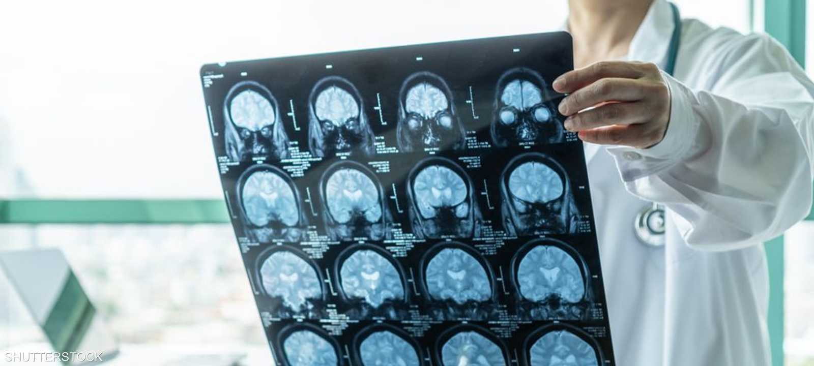 التهاب السحايا يسبب التهابا في السائل والأغشية المحيطة بالمخ