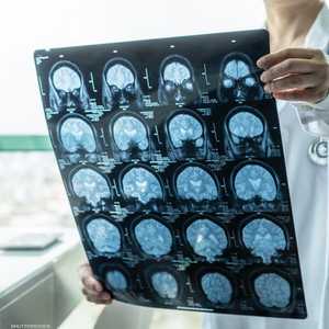 التهاب السحايا يسبب التهابا في السائل والأغشية المحيطة بالمخ