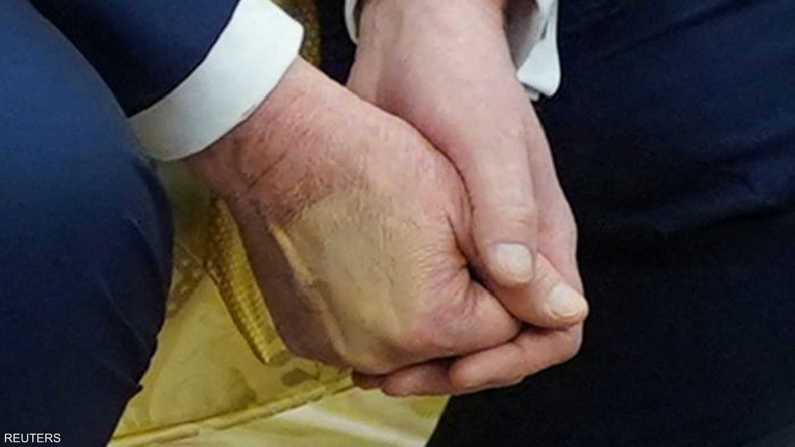 بدت الكدمة مغطاة بطبقة من المكياج