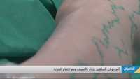 دوالي الساقين ..صرخة تعب مؤلمة مع كل خطوة
