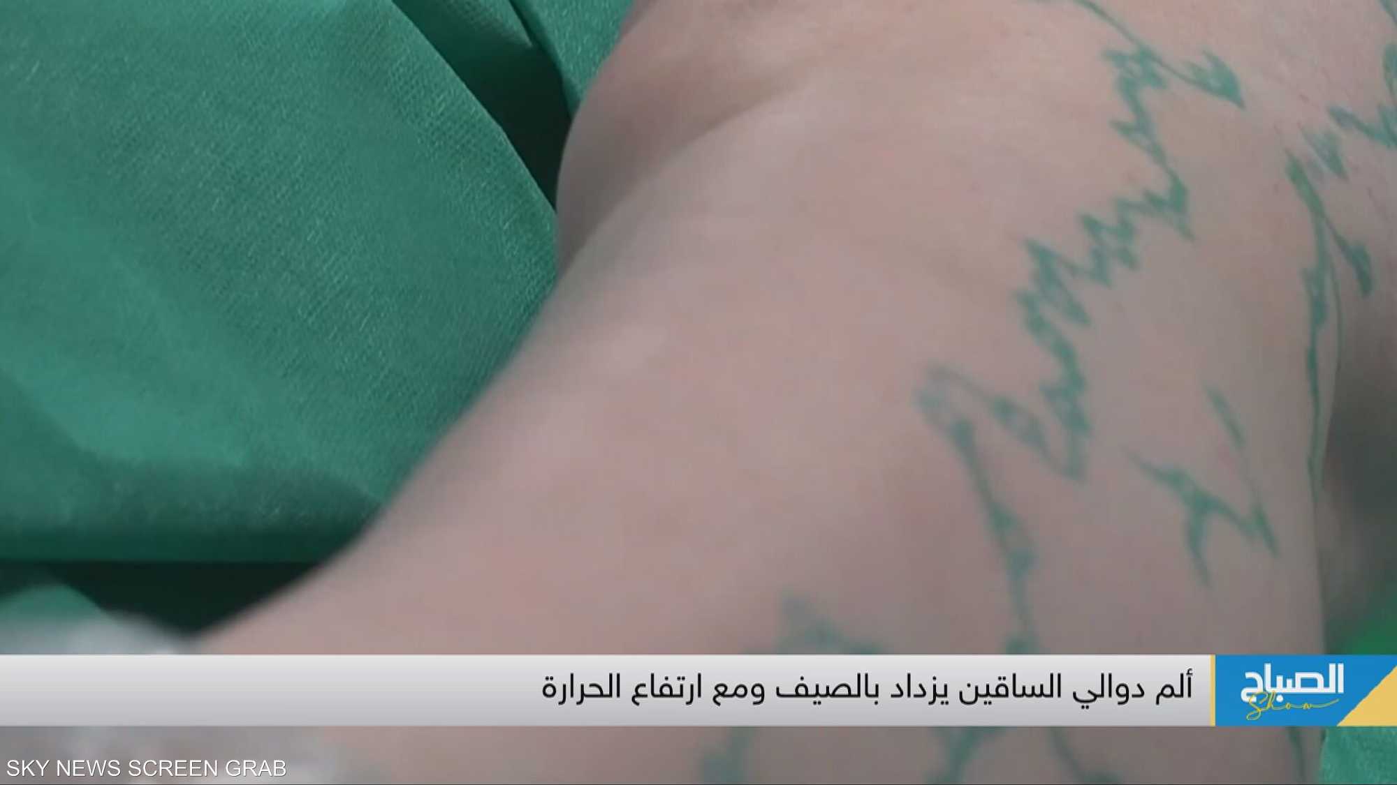 دوالي الساقين ..صرخة تعب مؤلمة مع كل خطوة