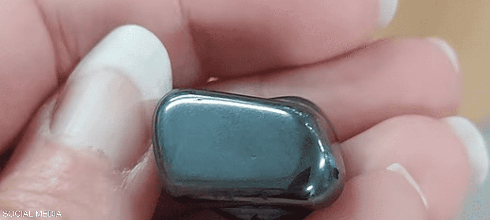 خضع الطفل لعملية جراحية عاجلة لإزالة المغناطيسين