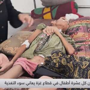 الجوع الحاد يفتك بأطفال غزة