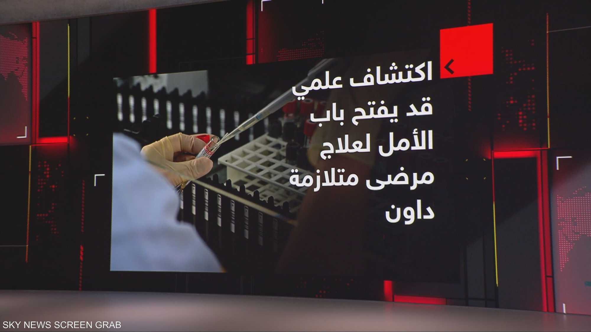 اكتشاف علمي قد يفتح باب الأمل لعلاج مرضى متلازمة داون