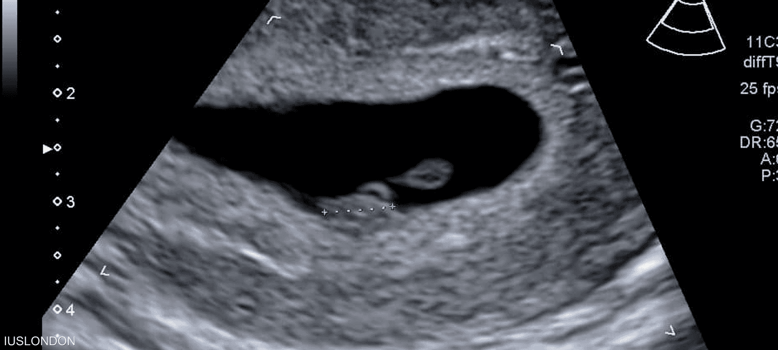 التصوير بالموجات فوق الصوتية