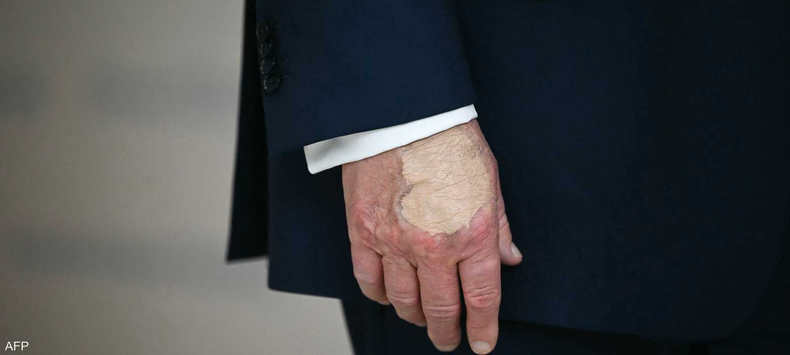 كدمة على يد ترامب