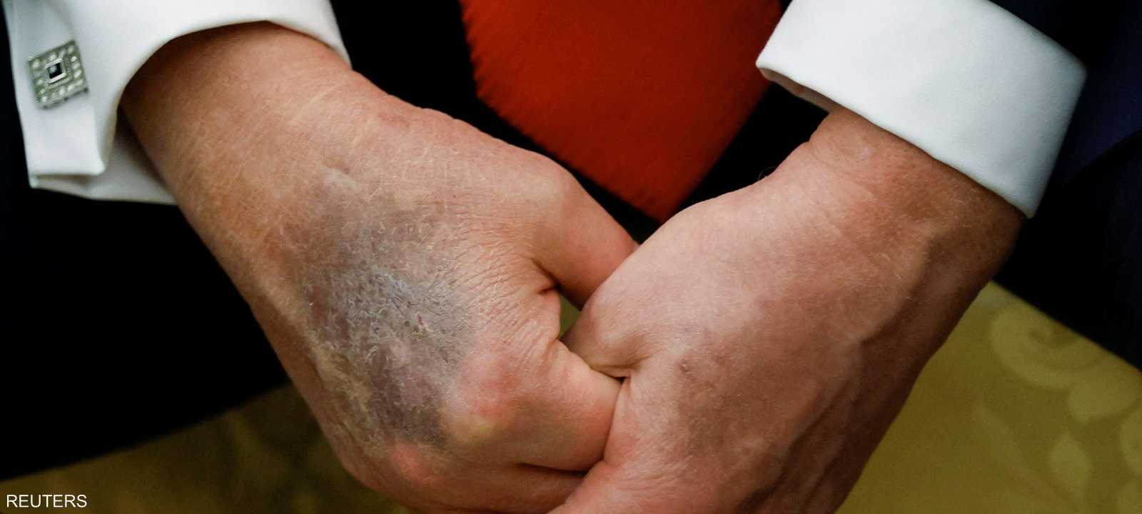 كدمة زراقاء داكنة على يد ترامب اليمني