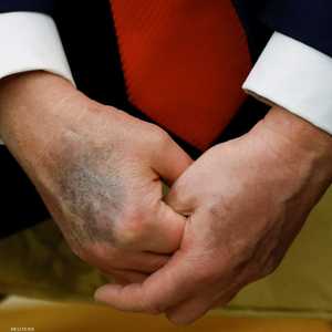 كدمة زراقاء داكنة على يد ترامب اليمني