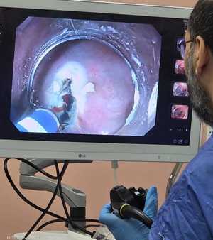 مصر أدخلت الذكاء الاصطناعي في جراحات القولون