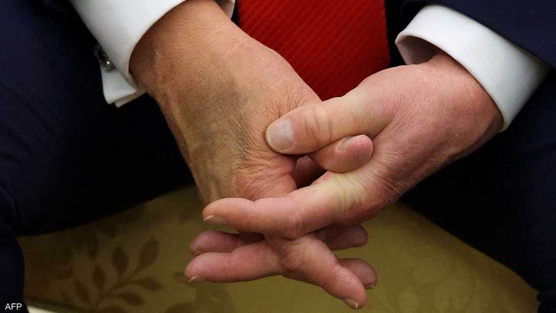 صورة حديثة ليد ترامب.. الكدمة ومساحيق التجميل تجددان الجدل