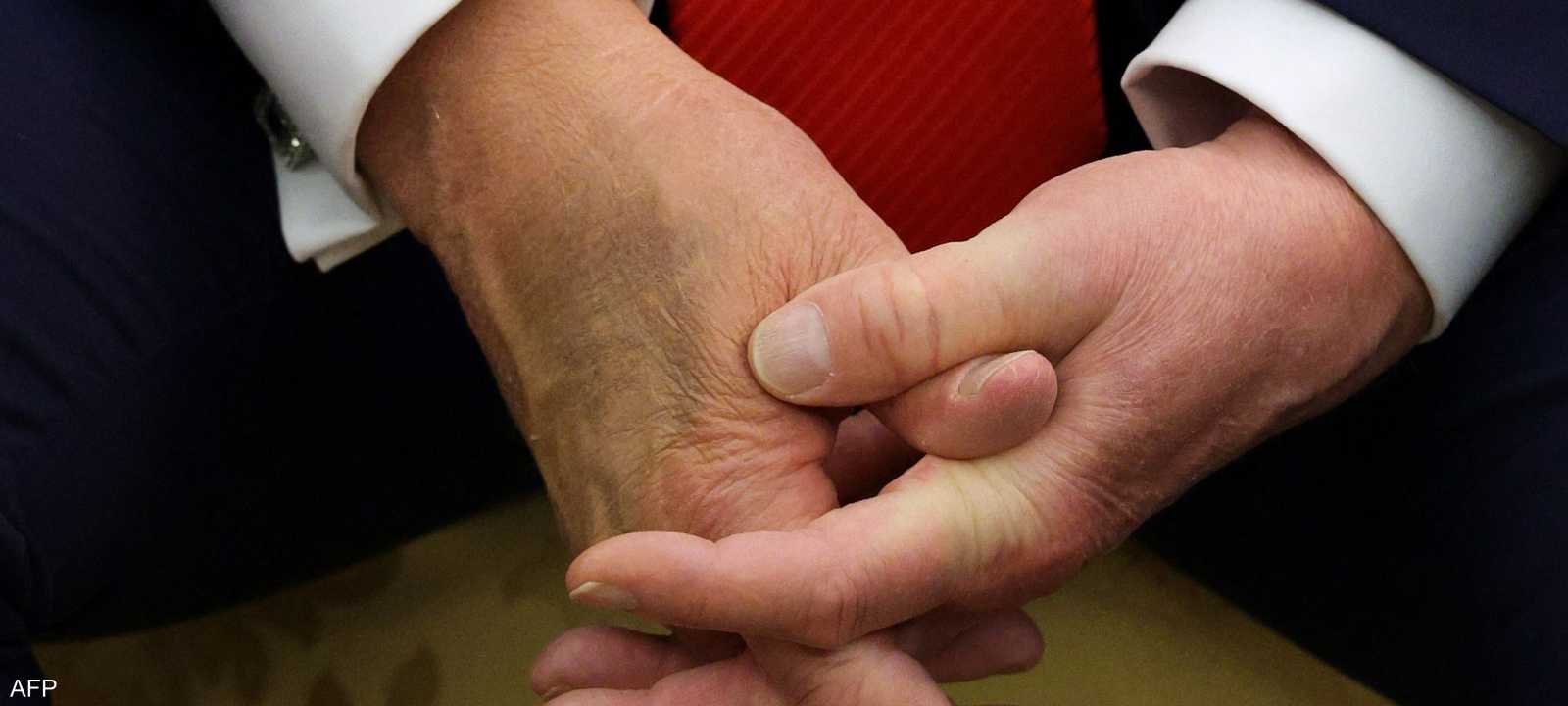 ترامب حاول إخفاء الكدمة بمساحيق التجميل