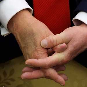 ترامب حاول إخفاء الكدمة بمساحيق التجميل