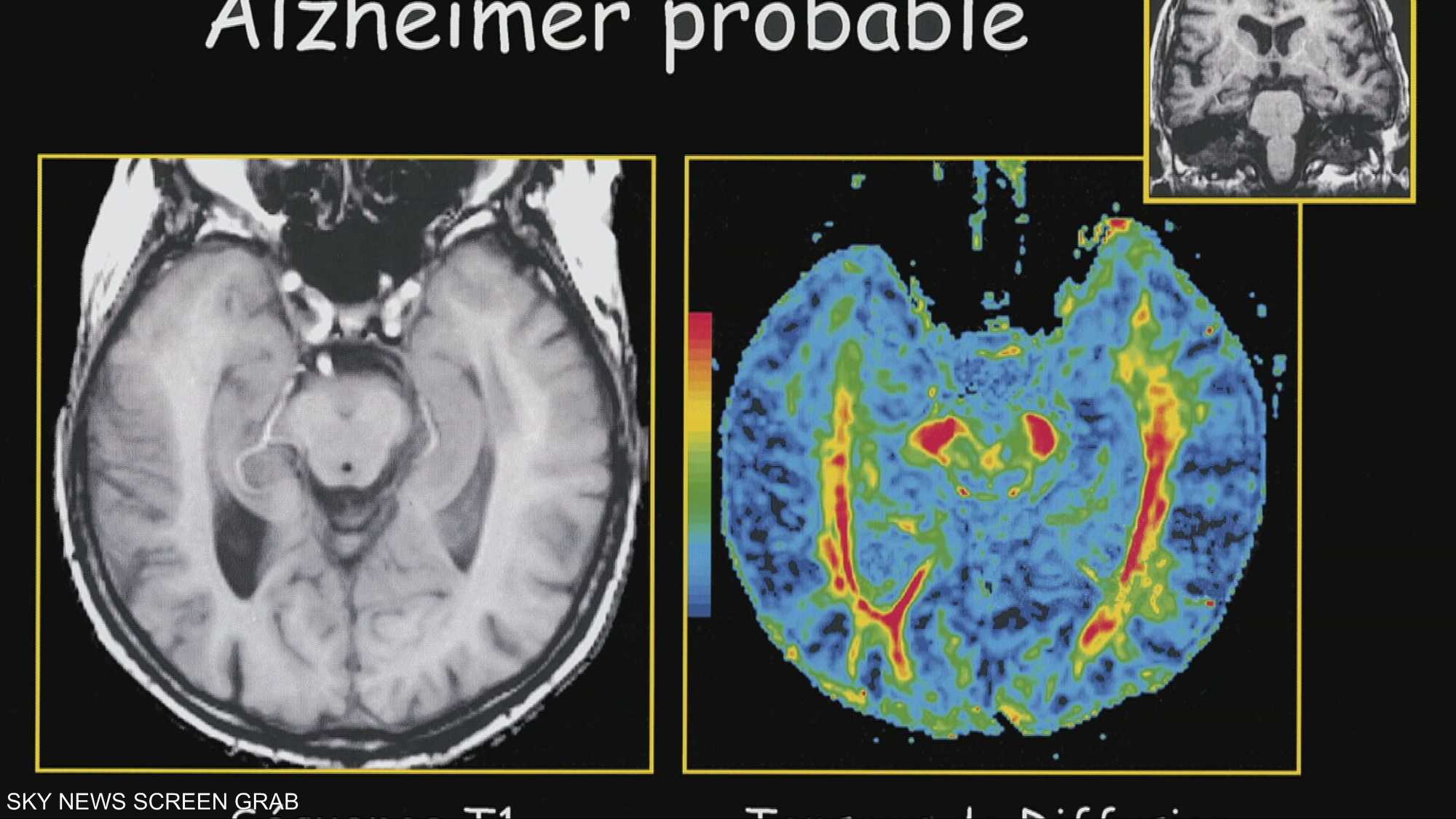 الذكاء الاصطناعي.. ابتكار إماراتي لدعم مرضى ألزهايمر