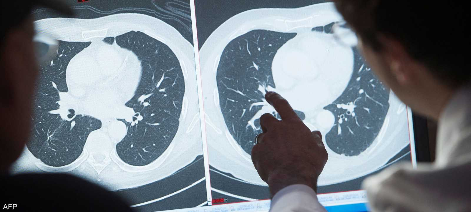 دراسة تتوقع ارتفاعا حادا في معدّل الوفيات بالسرطان