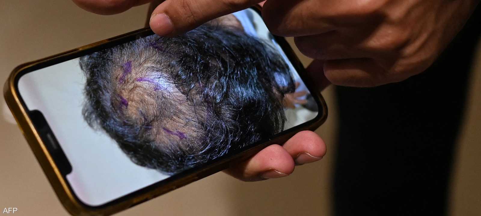 يمكن للمصل الجديد أن يعالج تساقط الشعر_أرشيف