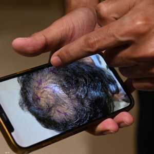 يمكن للمصل الجديد أن يعالج تساقط الشعر_أرشيف